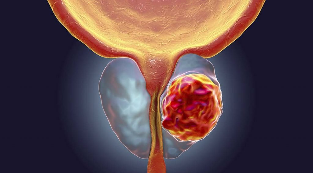 Mitos e verdades sobre o câncer de próstata - Correio Paulista